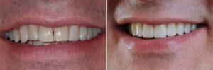 Veneers Before And After shots Veneers Before And After shots
