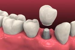 dental-implants-1 Dental Implants