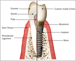 dental-implants Dental Implants