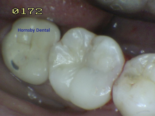 Hornsby Dental - Dental Fillings After2