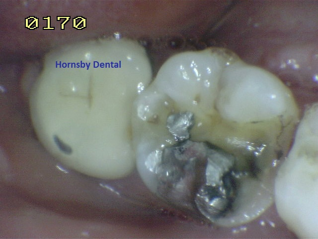 Hornsby Dental - Dental Fillings Before1