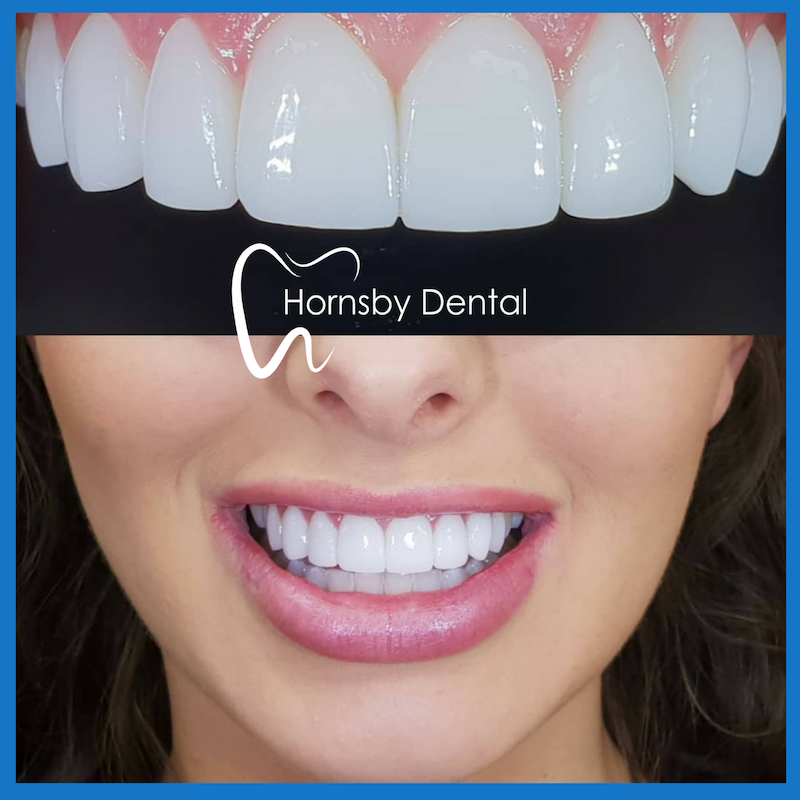 Dental veneers in Hornsby