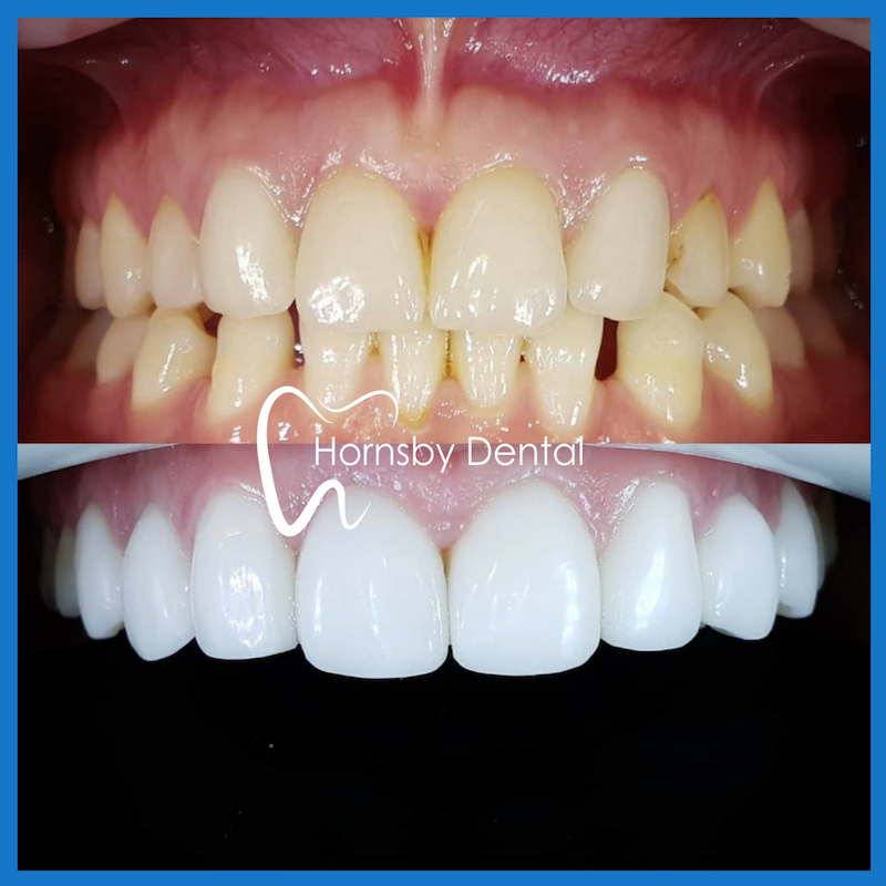 Porcelain veneers in Hornsby