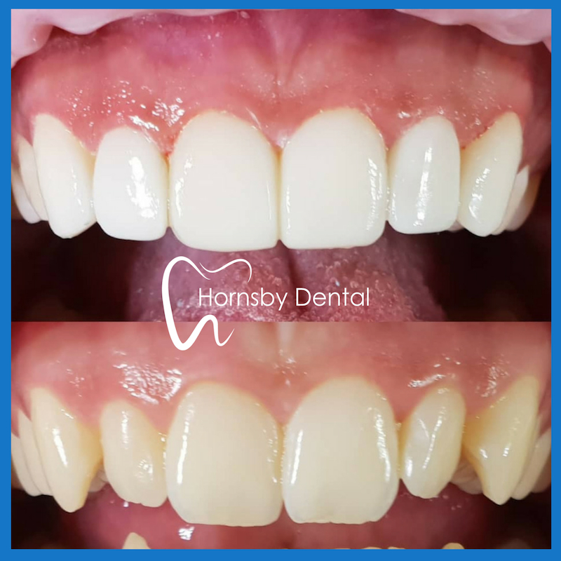 Best dentist for veneers in Hornsby