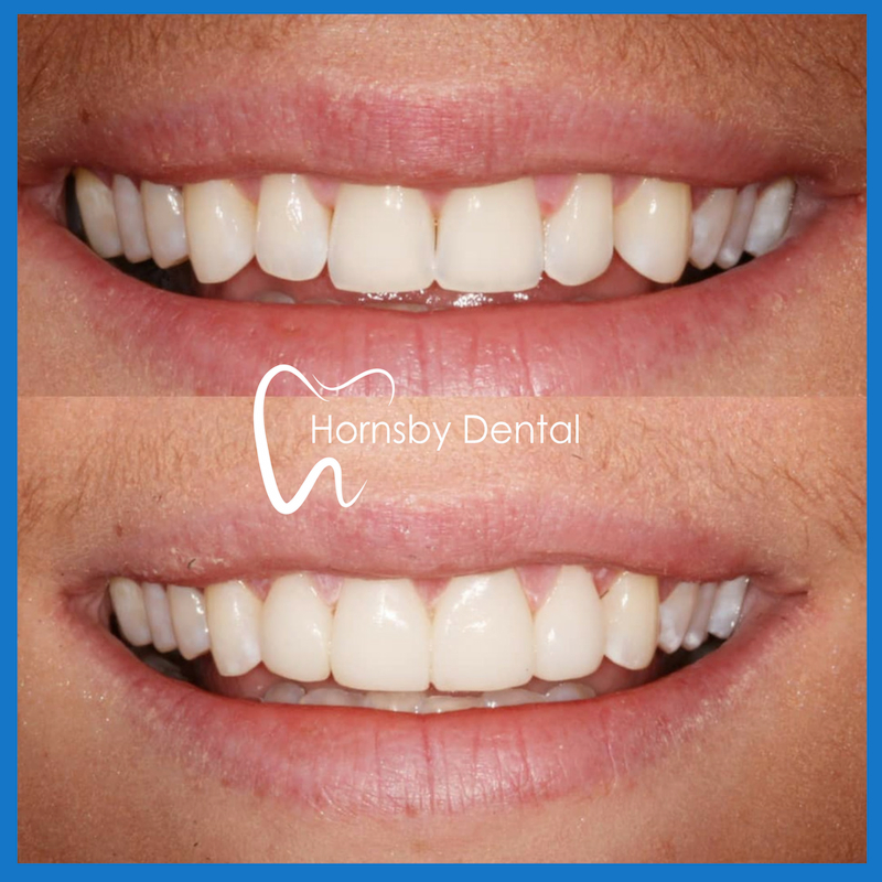 Veneers in Hornsby