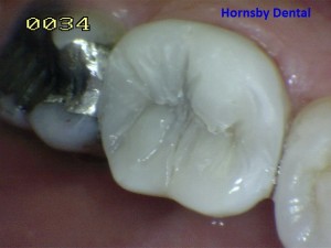 Hornsby Dental | Dental Fillings