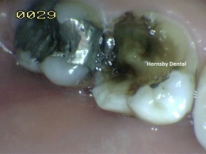 Hornsby Dental - Case 5 Before Hornsby Dentist