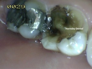 Hornsby Dental | Dental Fillings