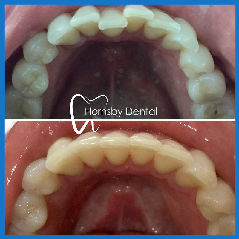 Clear braces in Hornsby