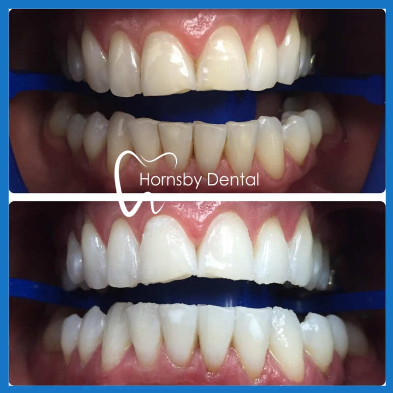 Teeth Whitening in Hornsby