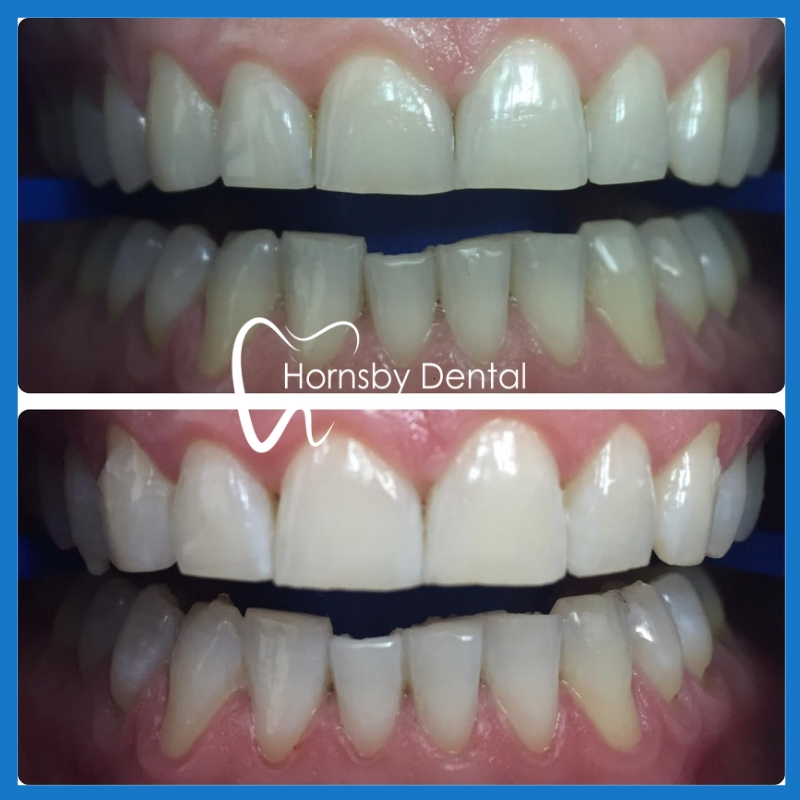 Teeth Whitening in Hornsby