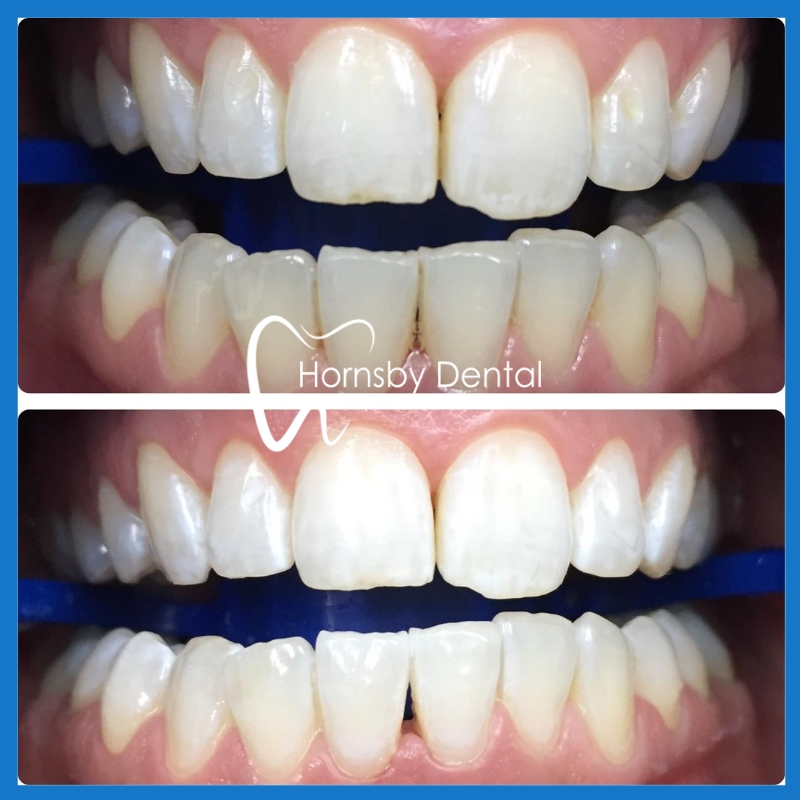 Best dentist for teeth whitening in Hornsby