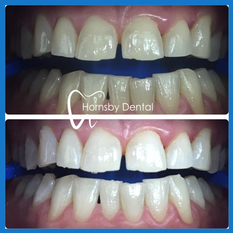 Best teeth whitening in Hornsby