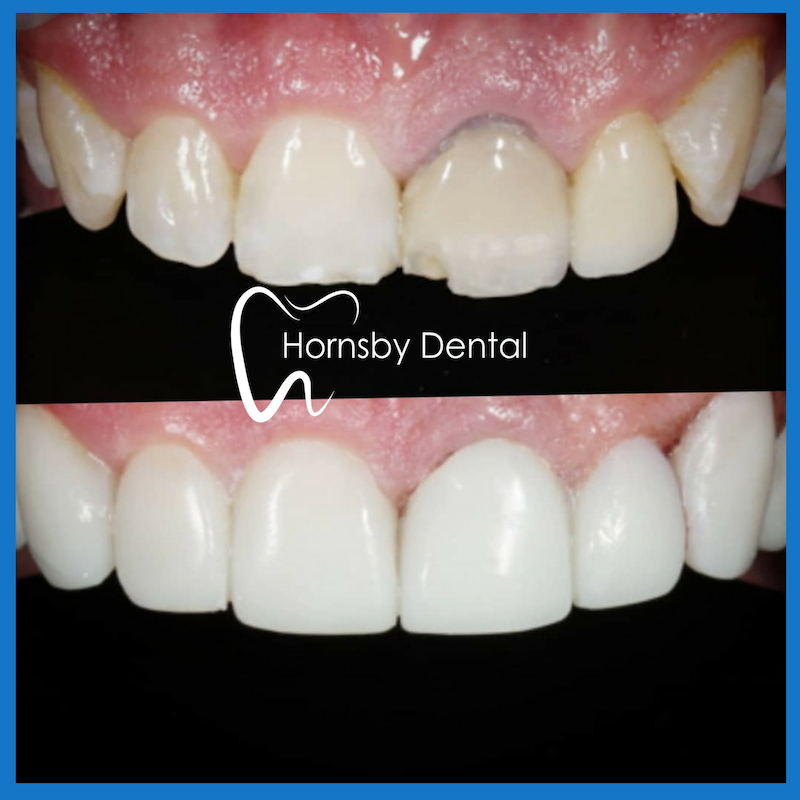 Best dental veneers in Hornsby