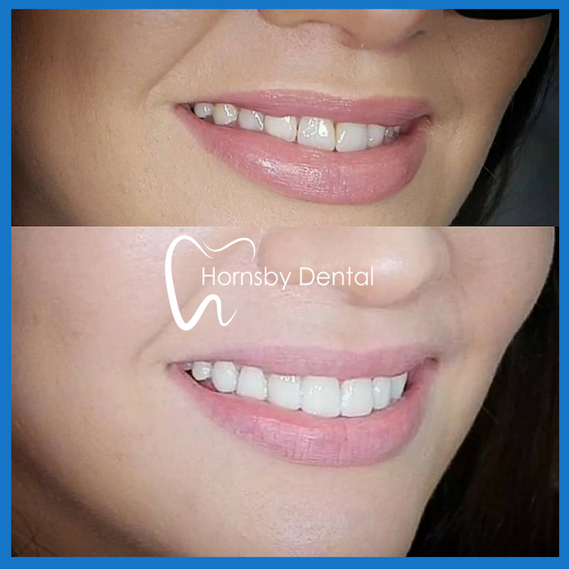 Affordable dental veneers in Hornsby
