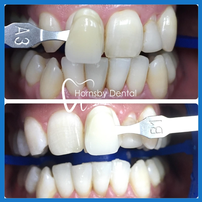 Affordable teeth whitening in Hornsby