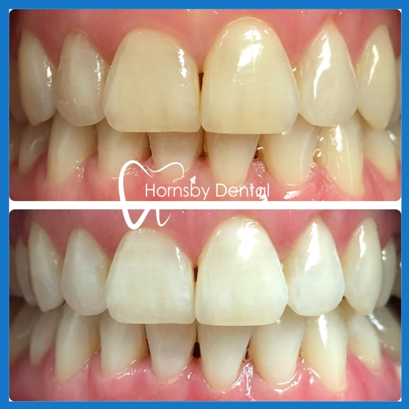Affordable teeth whitening service in Hornsby