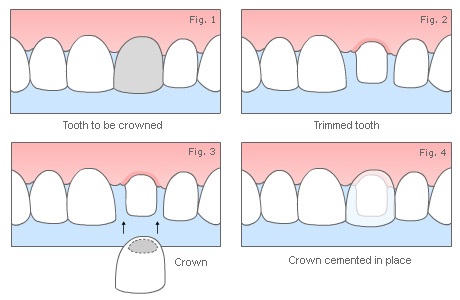 Hornsby Dental Crowns Fig 1