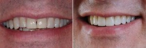 Veneers Before And After shots