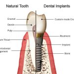 We have the best dentist that performs dental implant here in Hornsby.