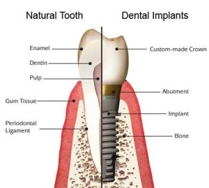 We have the best dentist that performs dental implant here in Hornsby.