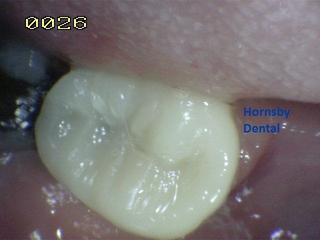 Hornsby Dental Clinic | Dental Fillings