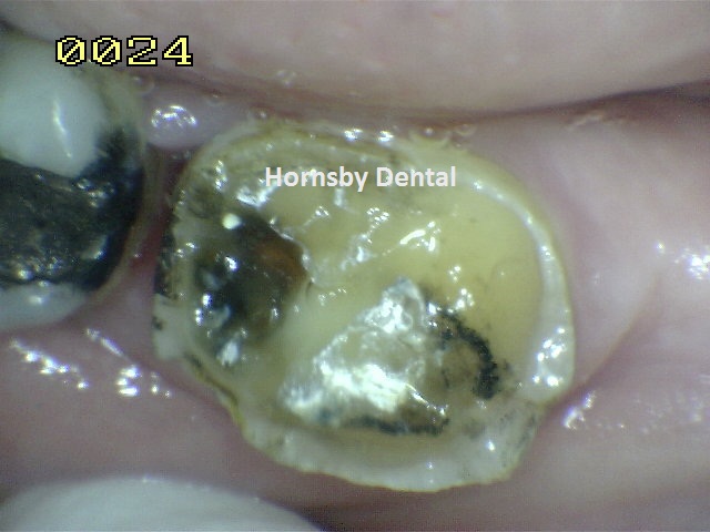 Hornsby Dental - Case 6 Before Hornsby Dentist