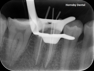 Hornsby Dental | Hornsby Dentist | Root Canal Therapy | Measurement