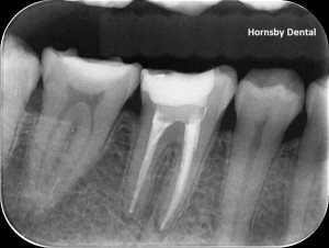 Hornsby Dental | Hornsby Dentist | Root Canal Therapy | Post