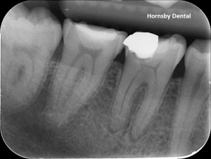 Hornsby Dental | Hornsby Dentist | Root Canal Therapy | Pre-Op