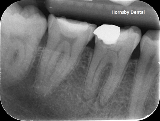 Case01-Before HD