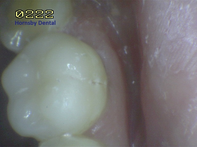 Hornsby Dental | Hornsby Dentist | Filling Case 11 After