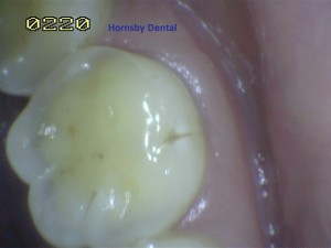 Hornsby Dental | Hornsby Dentist | Filling Case 11 Before