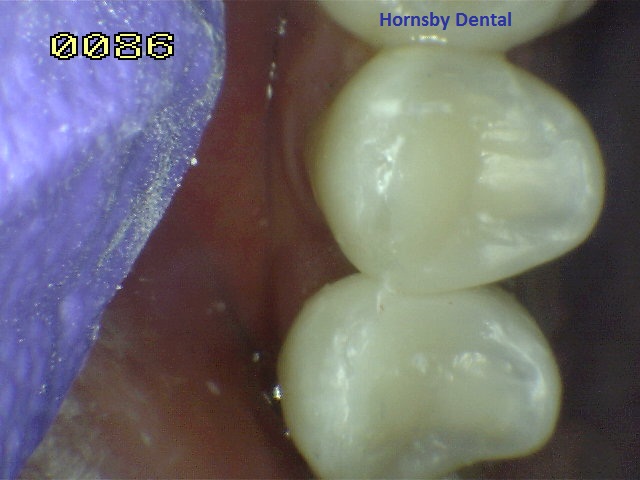 Hornsby Dental - Root Canal Therapy After