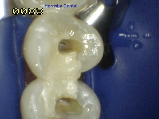 Hornsby Dental - Root Canal Therapy Before