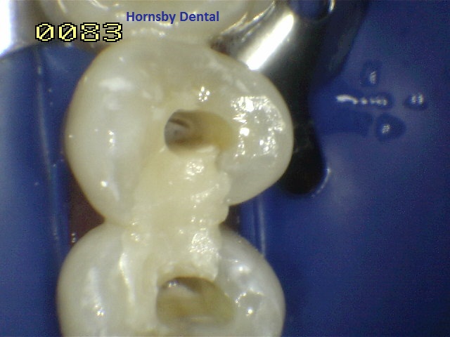 Hornsby Dental | Root Canal Therapy