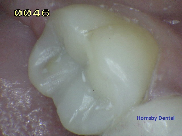 Hornsby Dental Clinic | Dental Fillings