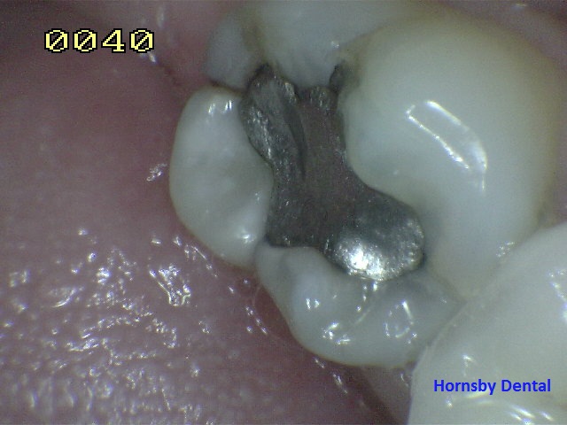 Hornsby Dental Clinic| Dental Fillings Hornsby Dental - Case 6 Before Hornsby Dentist