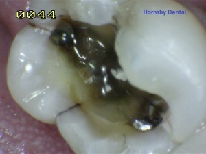 Hornsby Dental | Hornsby Dentist | Cosmetic Dentistry Case 8 During