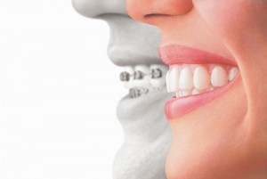 Hornsby Dental_Invisalign