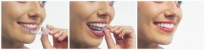 Hornsby Dentist Invisalign Trio