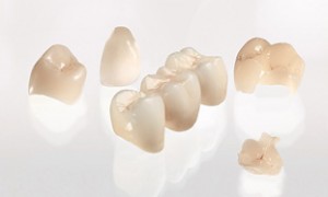 Ceramic Restoration Examples including Dental Crowns