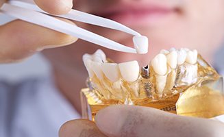 dental implant hornby Dental Implant Sydney