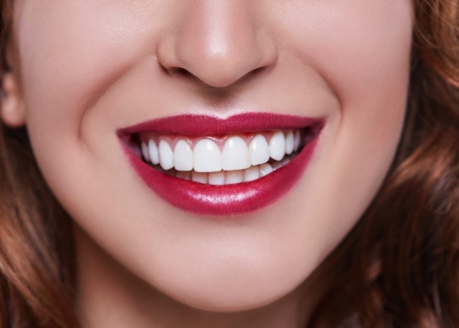 Composite Veneers in Hornsby