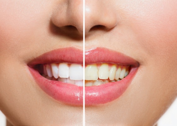 Professional teeth whitening Hornsby