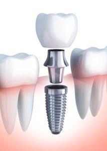 durability of dental implants in Hornsby