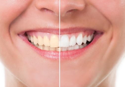 Pros and cons of teeth whitening in Hornsby