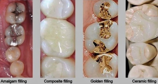 Which Dental Fillings Are Best?