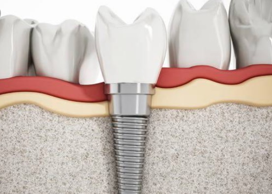 Dental Implant Recovery