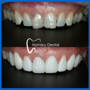 Dental Veneers Hornsby